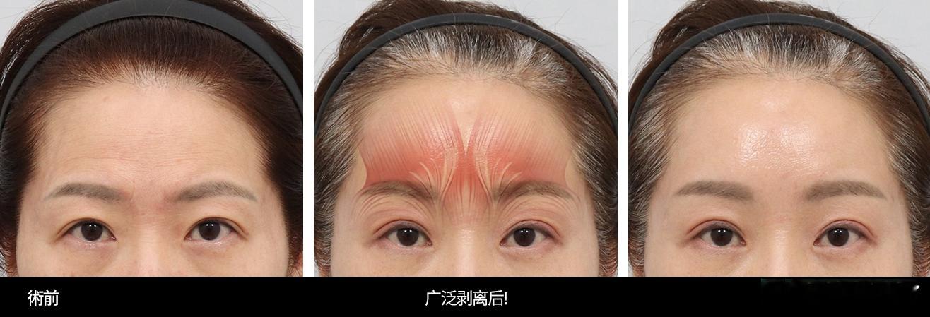 韩国额头提升的回落程度和保持时间，从来不取决于拉得多紧，而是取决于剥离得有多深、