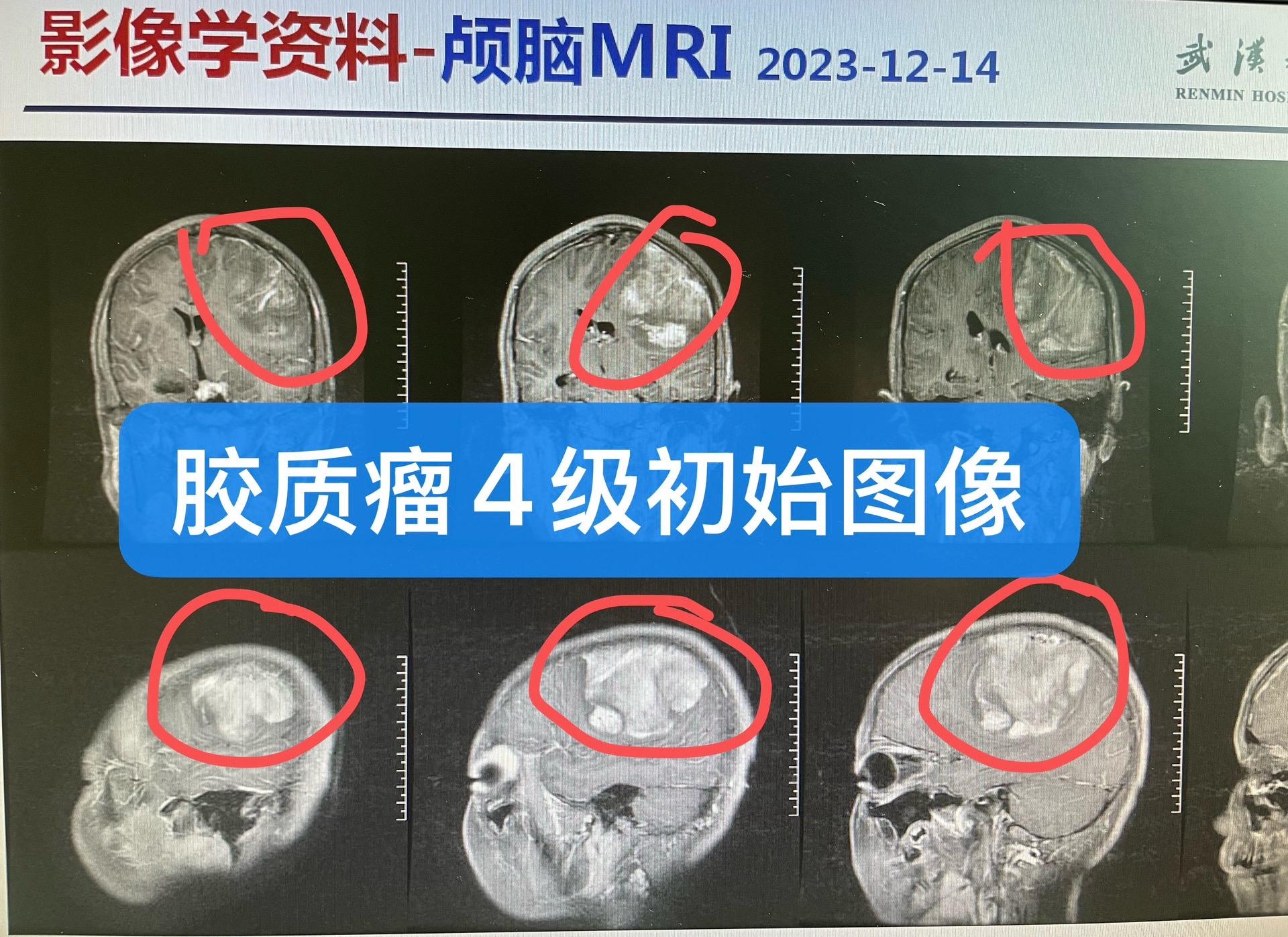 胶质瘤4级已经2年，持续维持治疗中。肿瘤体积较大，随访图呈现，术后也做...
