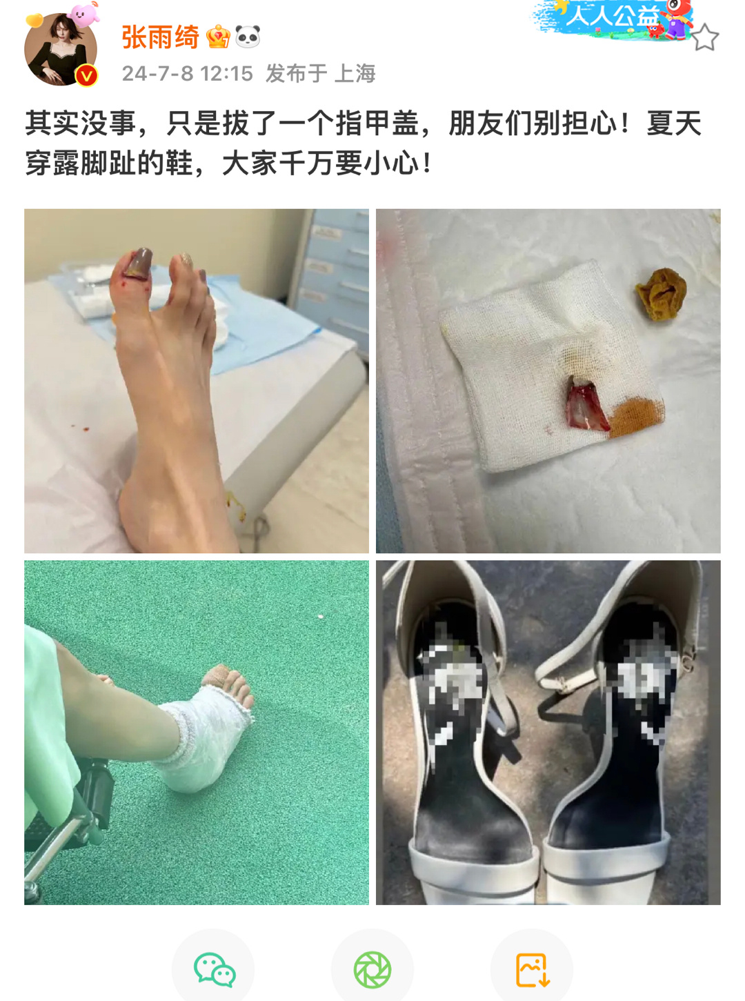 张雨绮脚受伤，把指甲盖拔了看着好疼，慎点！ ​​​