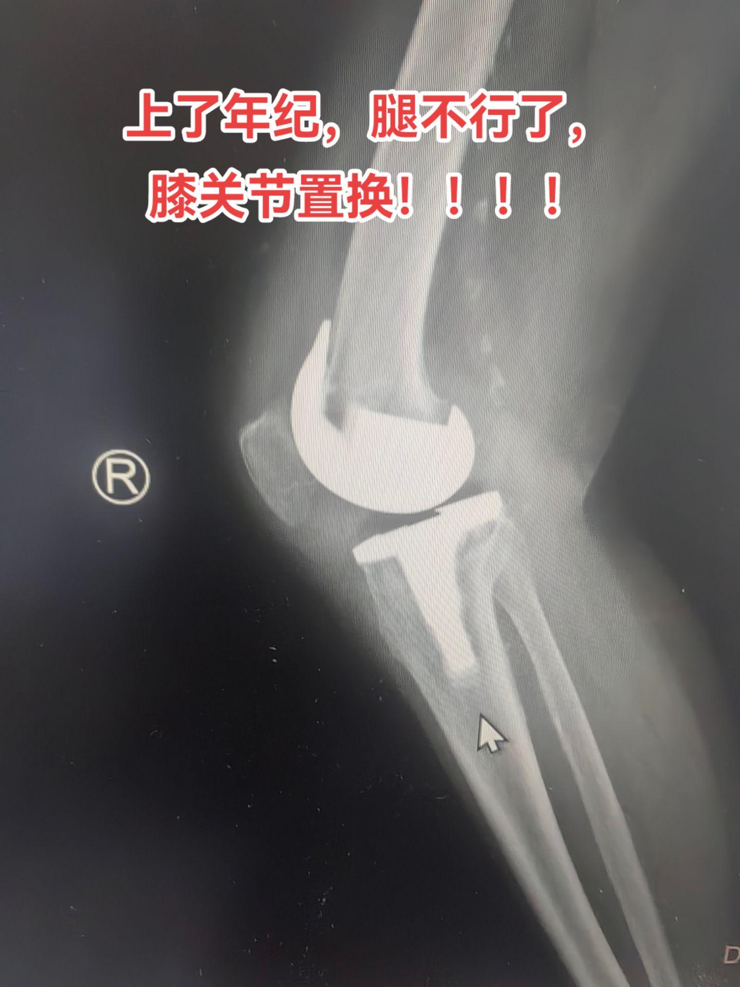 膝关节置换 医学影像