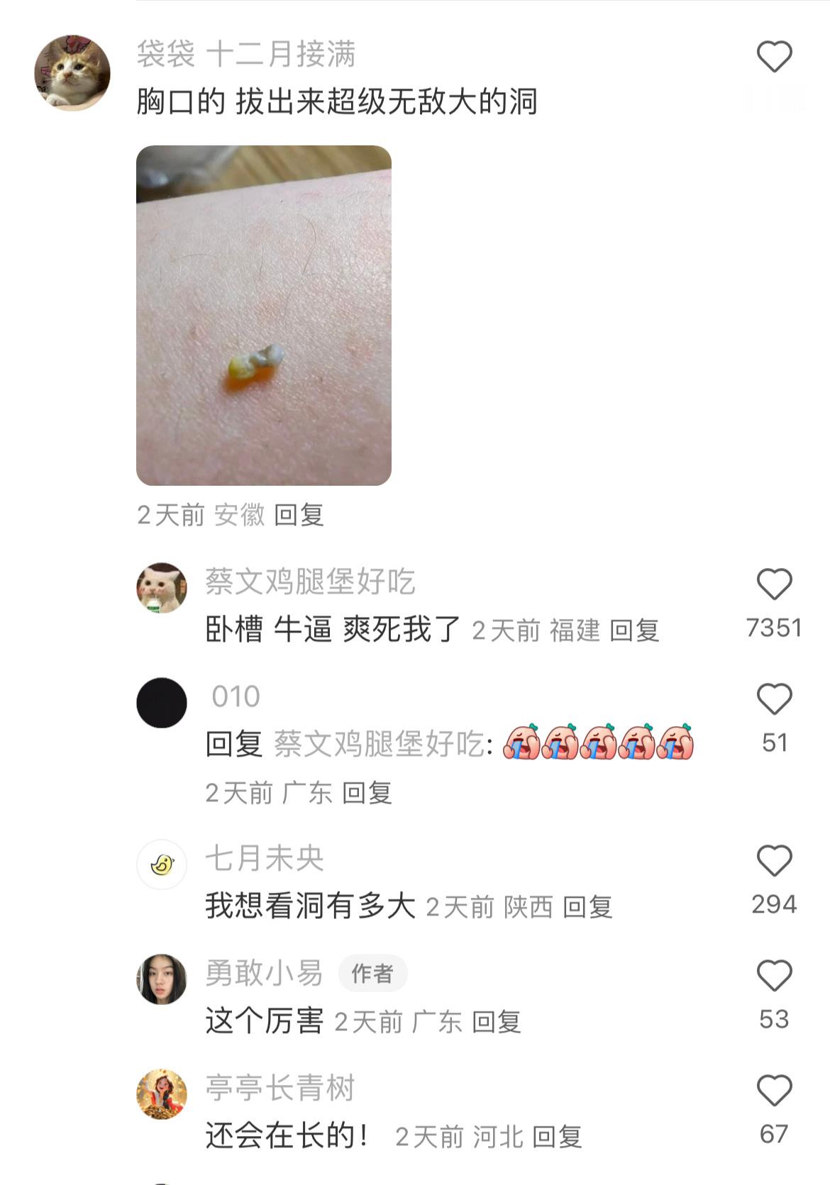 谁懂一下就把痘根扯出来的快乐？！ 