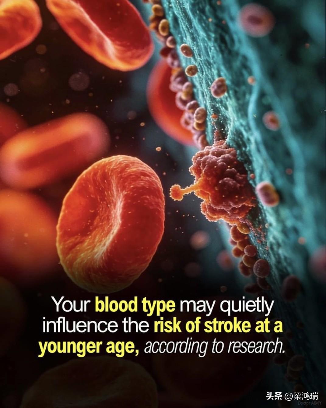 美国一项研究证明血型与60岁前中风风险之间隐藏的联系。这项发表在美国《神经病学》