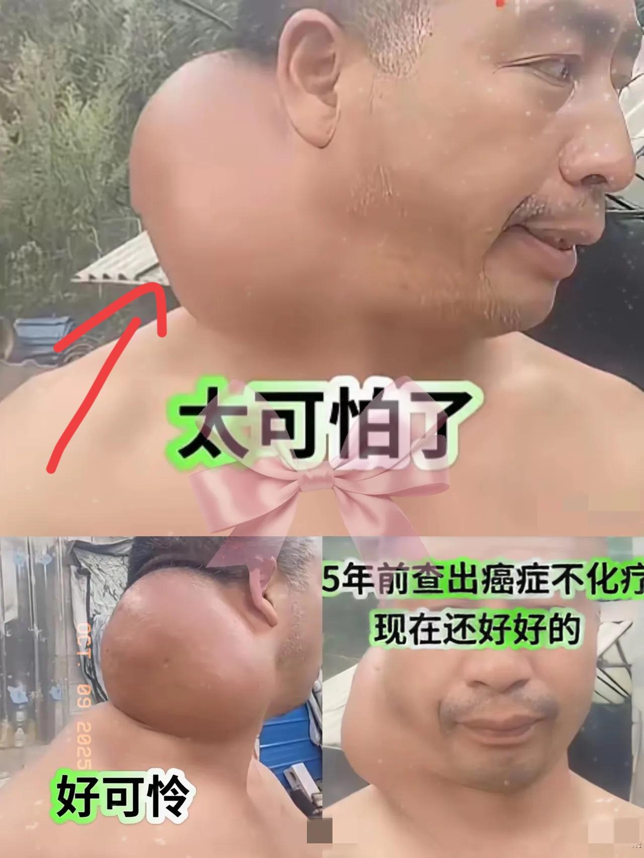 深圳有位大哥15年前查出癌症，

   拒绝化疗靠平常心挺到现在，

   说“