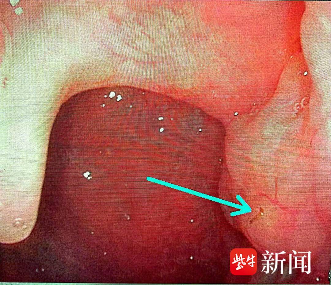 【#女子吃烧烤被竹签刺卡喉#】#医院假期单日接诊近10例卡喉患者#国庆假期亲朋好