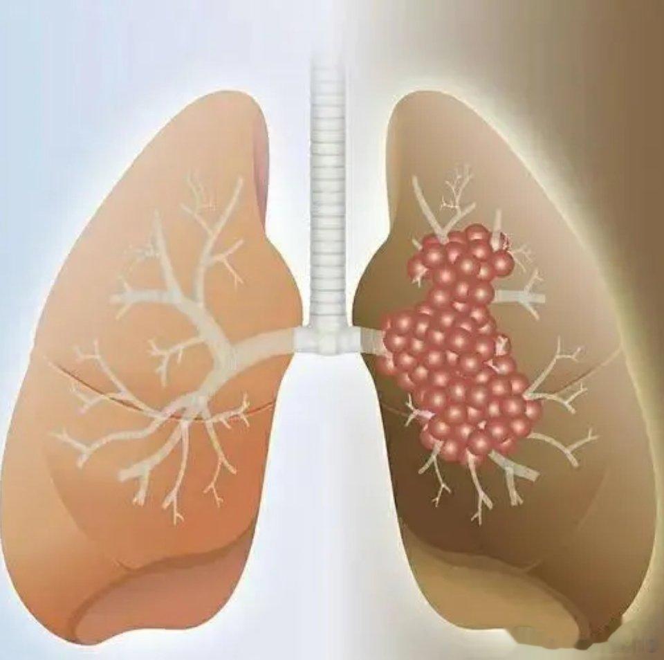 肺癌早期7个信号！1、声音嘶哑：声音嘶哑是由于肺部侵犯喉返神经所致，约20%-3