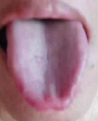 精气亏虚多年伴湿瘀，辨证补虚化湿，逐步恢复健康状态






有不少男同志到了