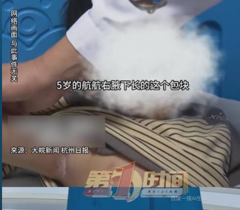后背发凉！9月28日报道，杭州一名5岁男孩腋下突然长出小硬块，起初家长没放在心上