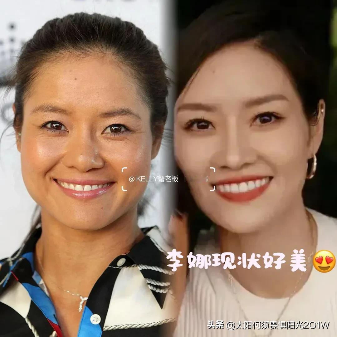 澳网冠军李娜整容，现状与十年前判若两人❓2024年01月25日，在这个澳网夺冠十