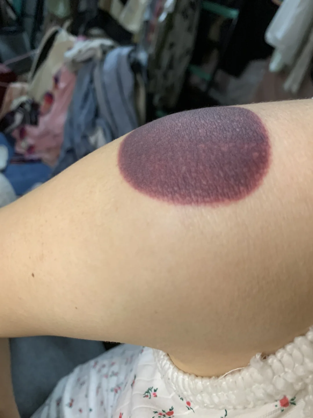 没见过这么深的拔火罐印子