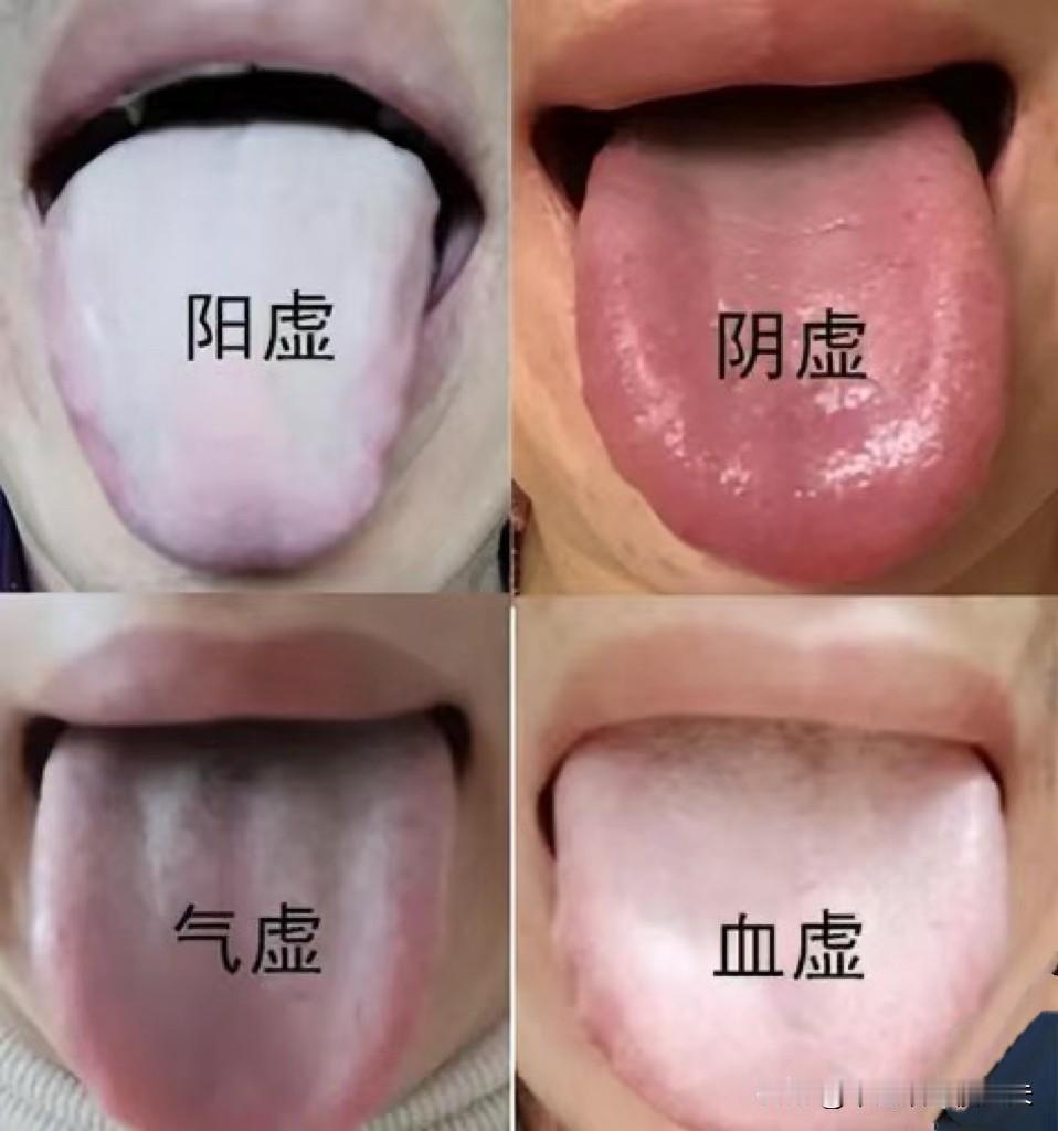 教你一分钟学会，分辨身体气虚、血虚、阴虚、阳虚！
1、气虚
表现：提不起精神、经