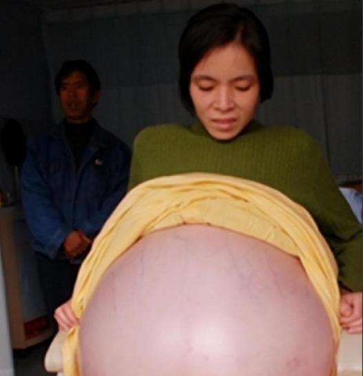 2007年，广东女子肚子暴涨一年迟迟不生，真相揭开后，伴侣弃她而去，流浪两年绝处