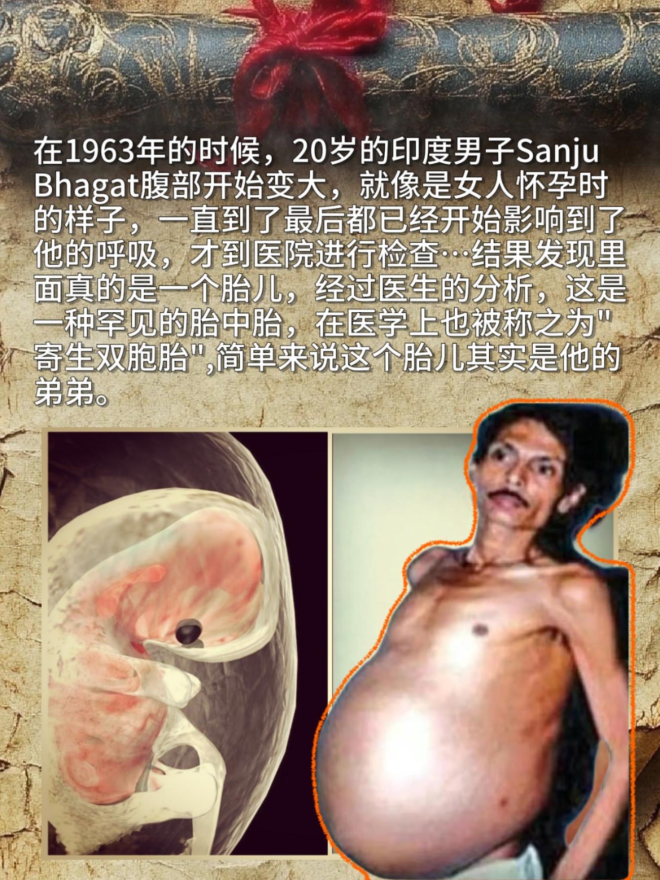 1963年的时候，20岁的印度男子Sanju Bhagat腹部开始变大...