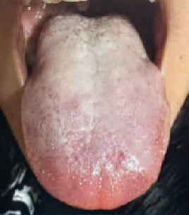 舌苔这么厚，怪不得下面不给力，赶紧给身体祛祛湿吧！

患者主诉：宗筋起立困难，时