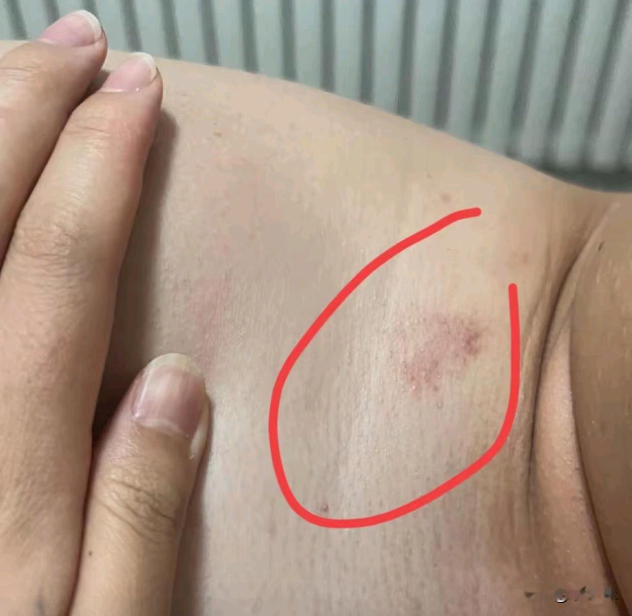 他说是蚊子咬的   我看着不像