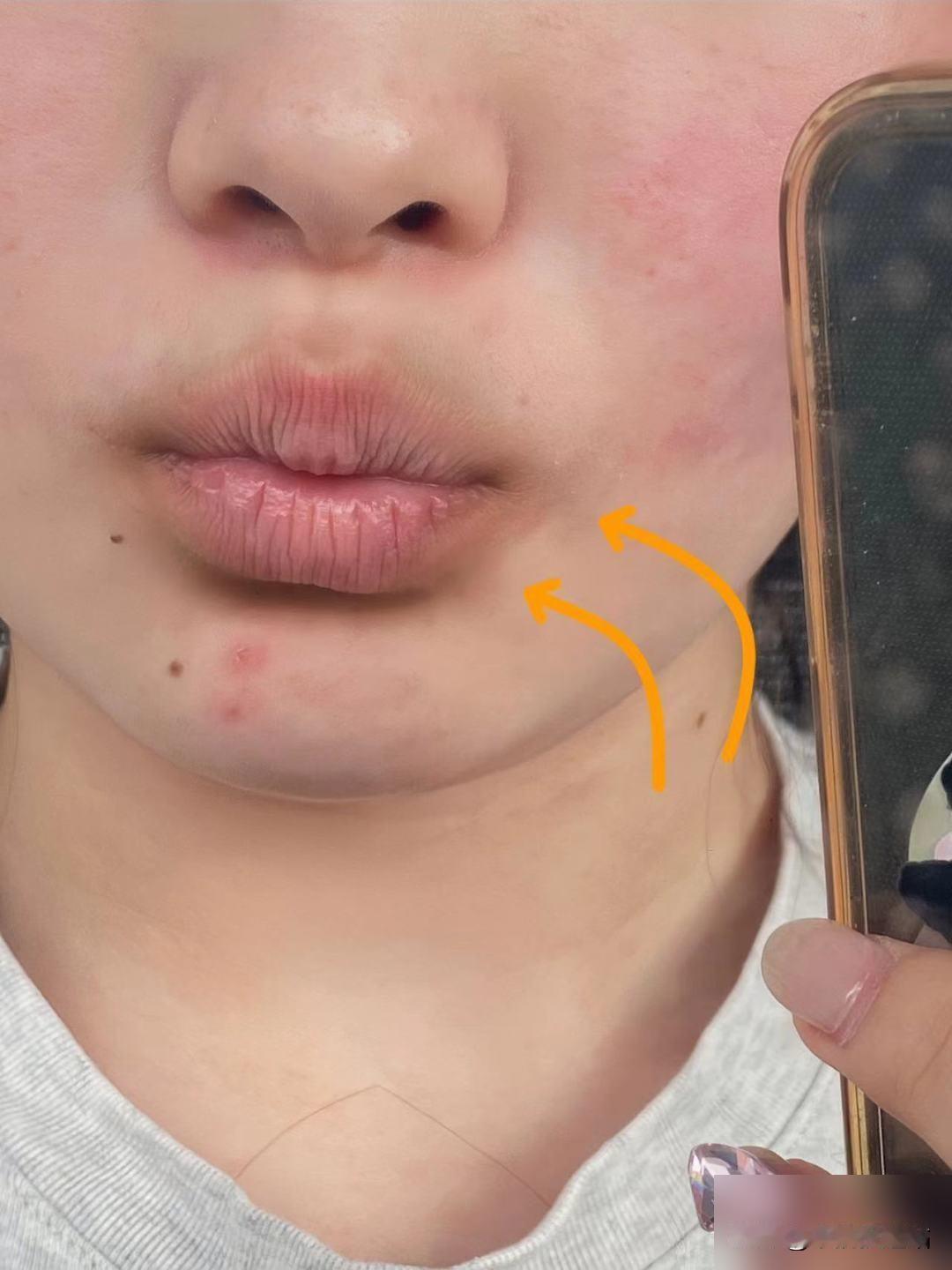 重度唇周黑过来人上岸的大实话！

纯个人分享！想提亮唇周的姐妹一定要看！ 先具体