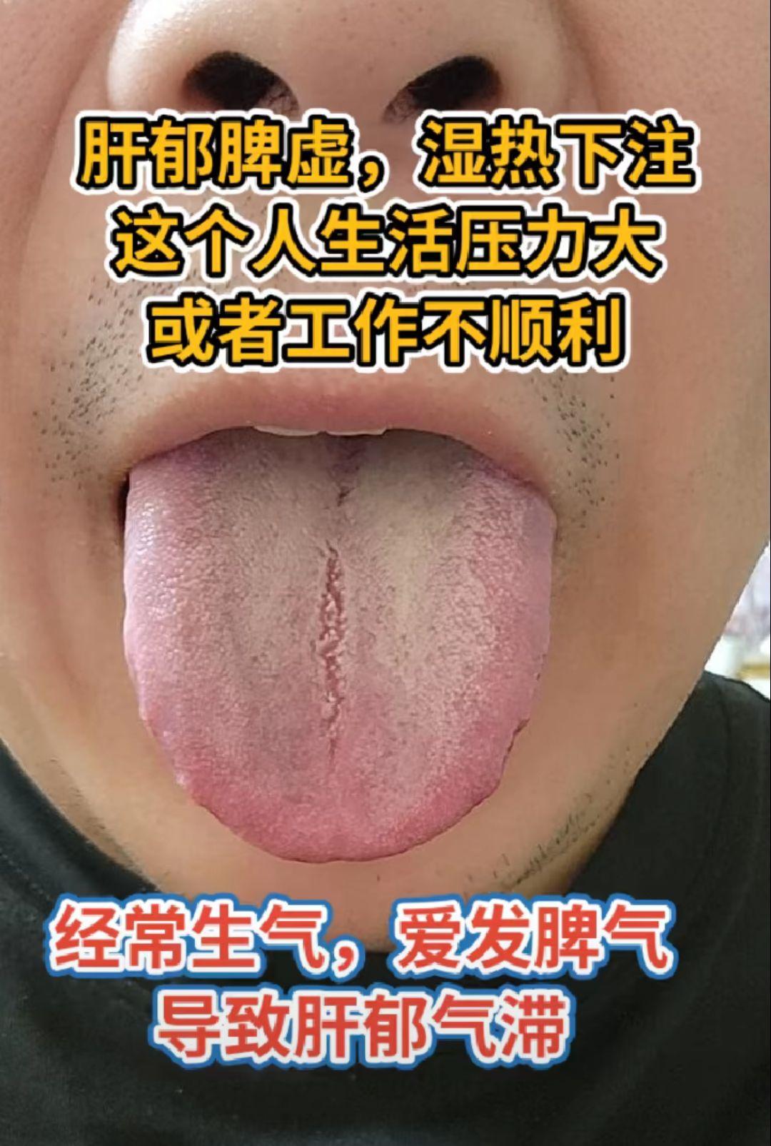 湿热体质看过来 来看一期湿热体质舌象