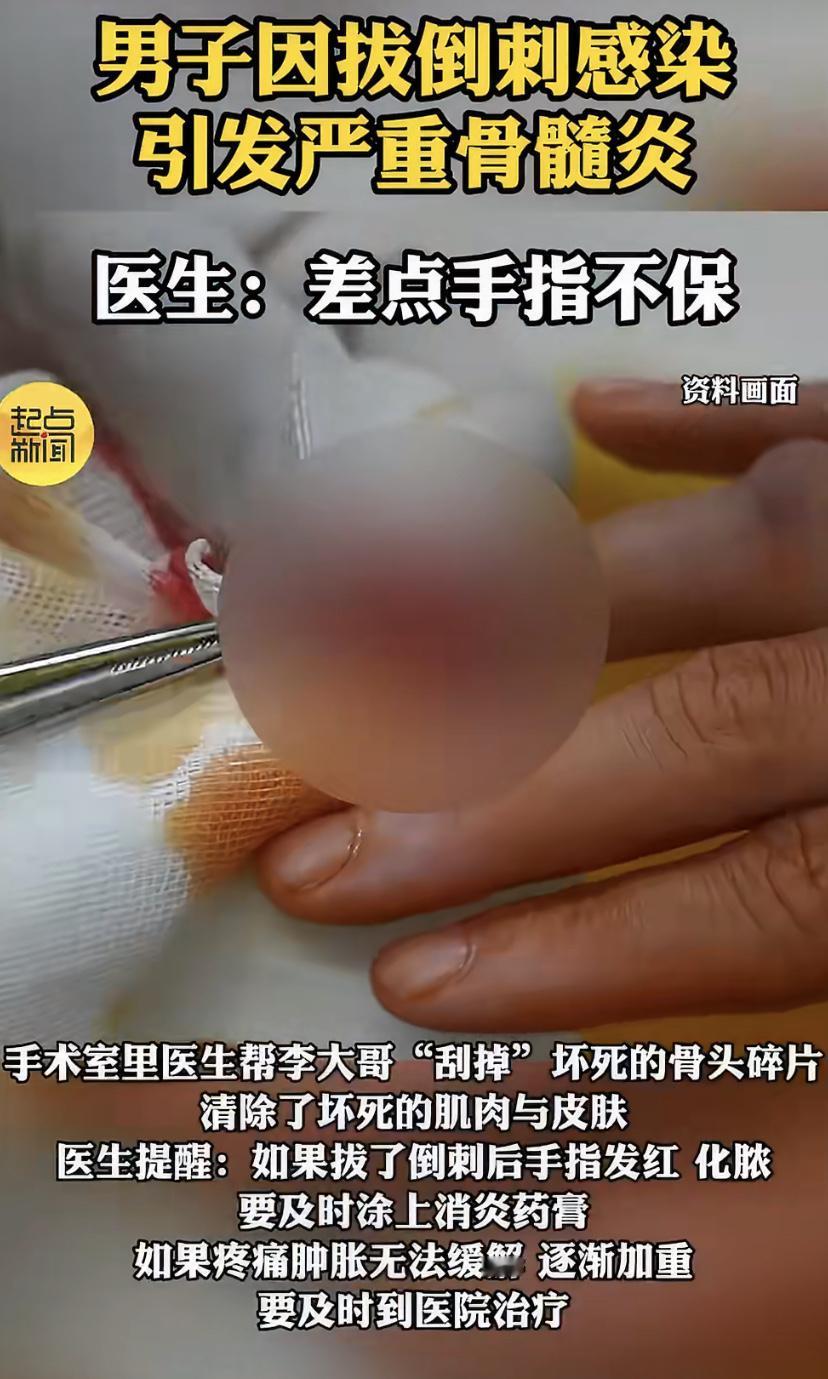 最近杭州一位李先生因为一根倒刺遭了大罪。他就是随手把食指上的倒刺一撕，第二天指头