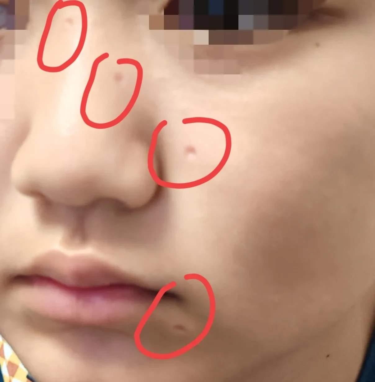 有没有懂的来说说！激光点痣之后脸上全是小凹坑，看得人心里发慌😨
 
这些坑后期