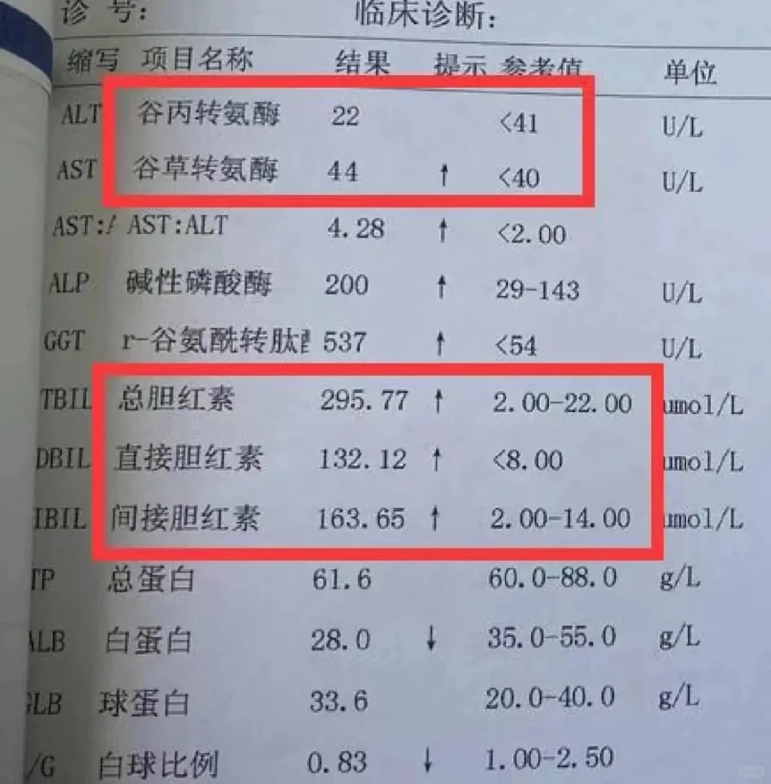 肝硬化转氨酶升高不可怕，这1指标高更危险，小心肝衰竭！ 在门诊接诊的肝...