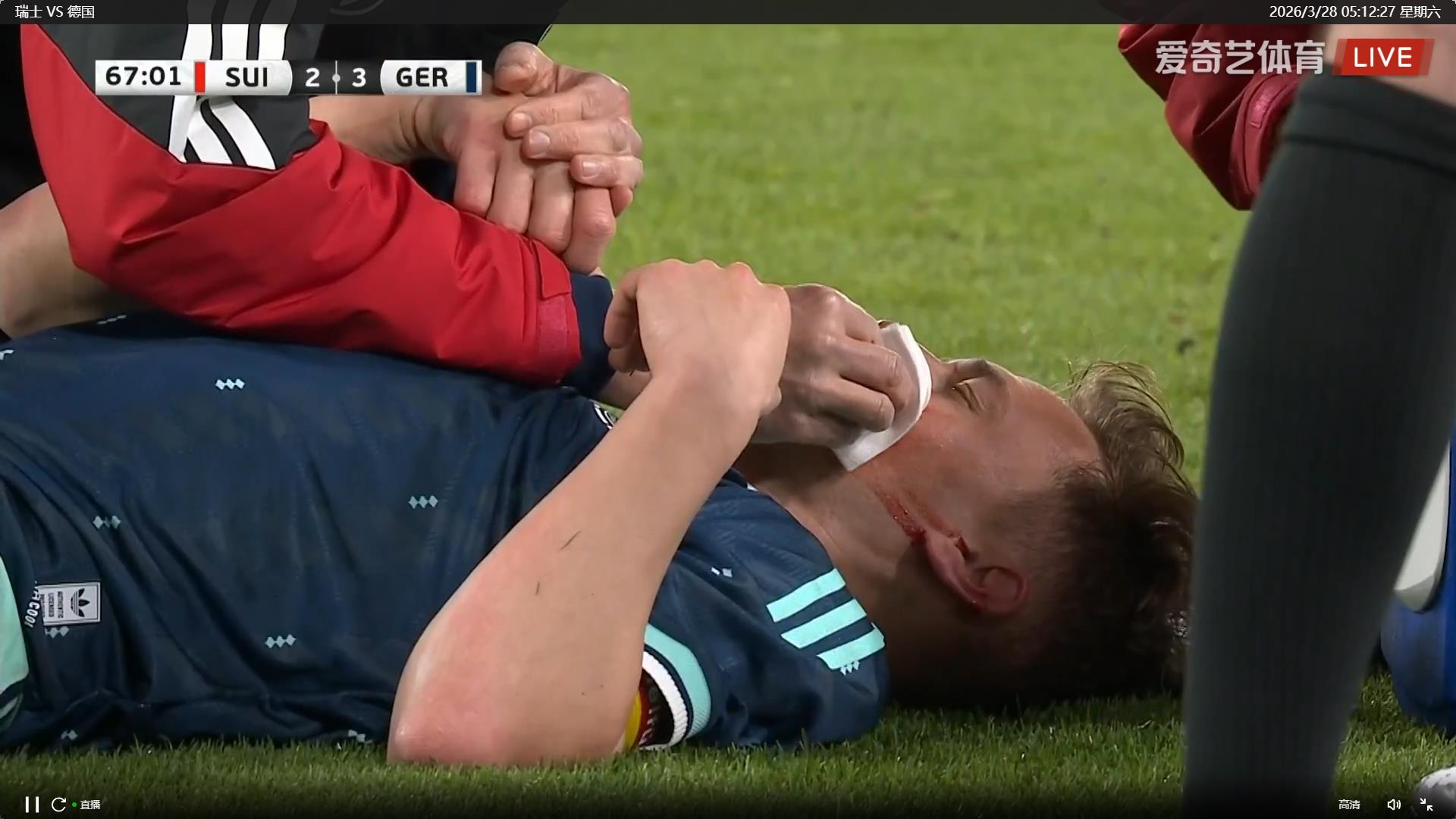 基米希这下要毁容？流了好多血，但应该没啥大事…… 