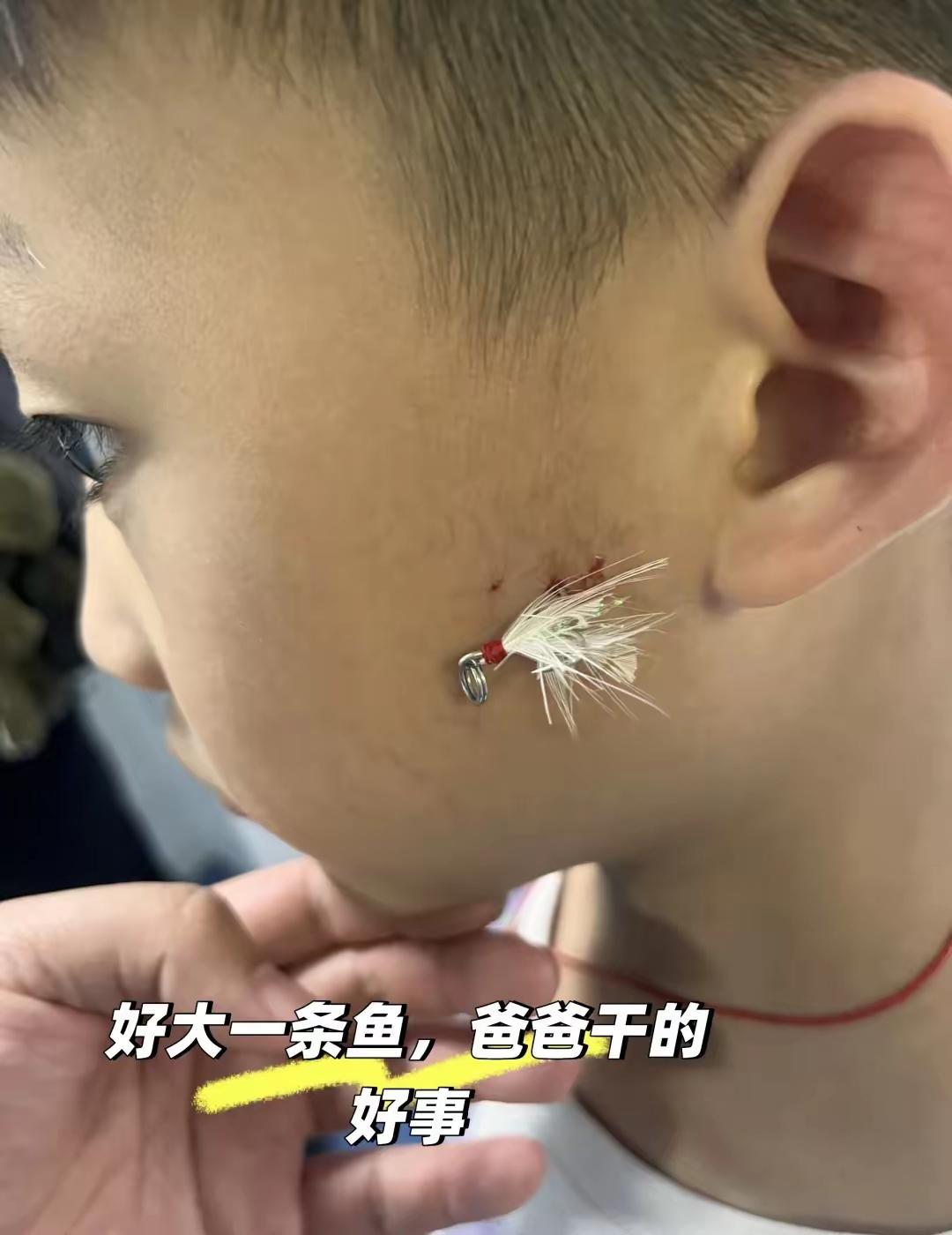 爸爸带儿子去钓鱼，结果鱼没有钓到，钩子刮到了孩子的脸上，到医院打的麻药，医生硬生