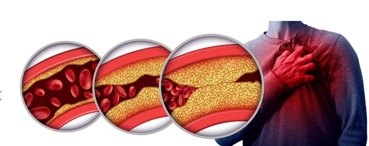 血管斑块能逆转吗？血管科医生直言：做好这 5 件事相当于给血管 “洗个澡”
话说