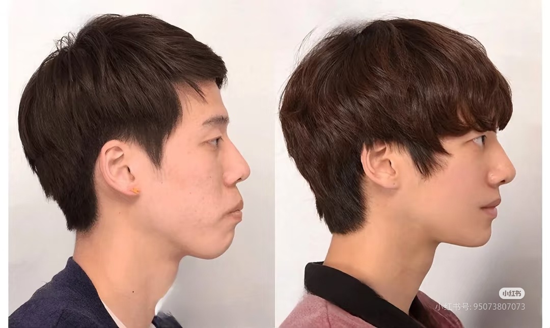 只做正畸的效果[傻眼]威虫你怎么整整牙吧。。。 ​​​