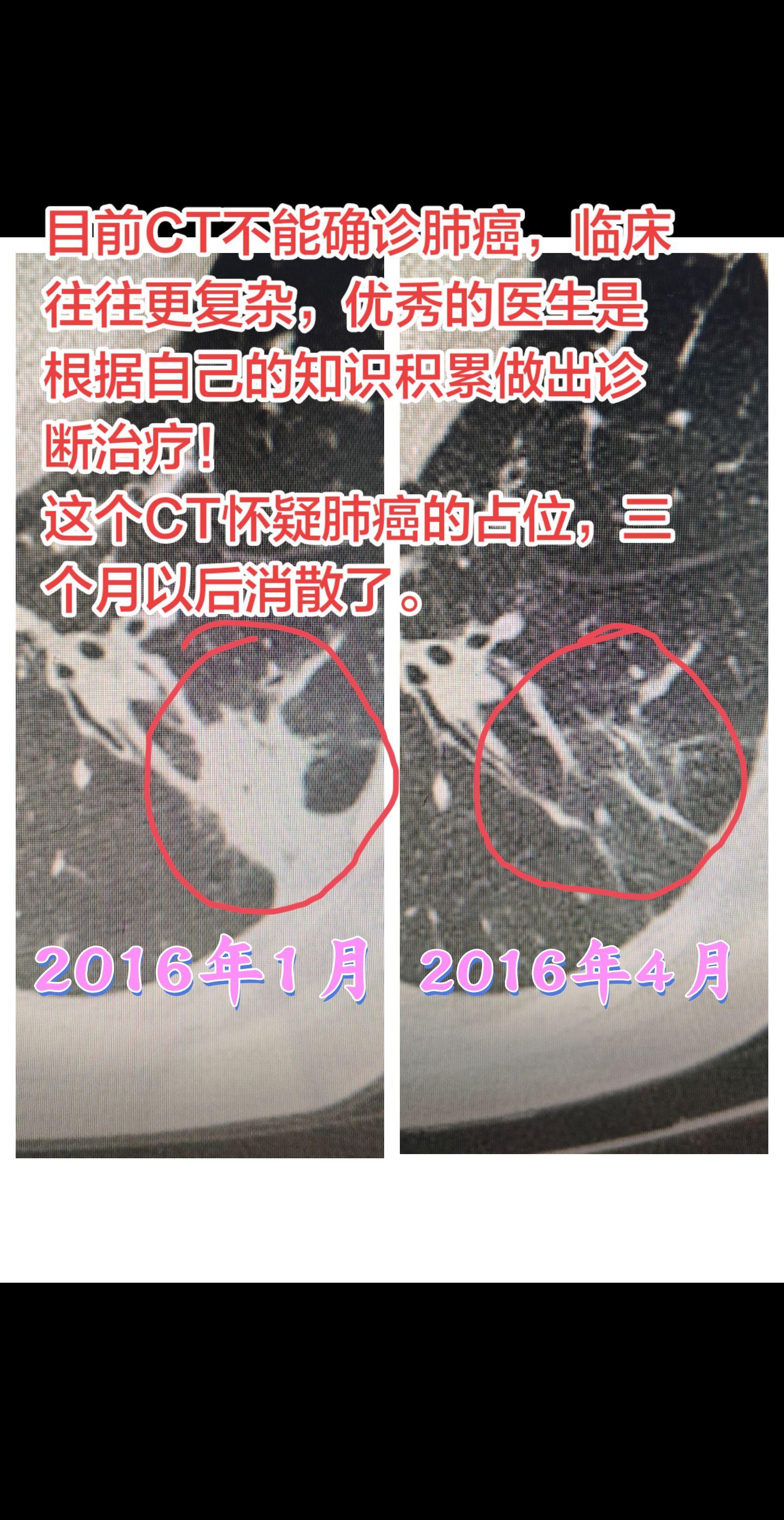 CT能代替医生的诊断吗？男性，70岁，咳嗽一个月就诊，检查CT发现左下...
