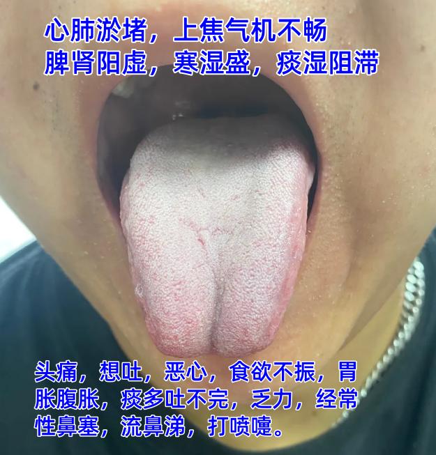 公益舌诊继续，这会不忙，抽空来帮大家继续分析舌象

如果有需要，可以尽管把你的舌