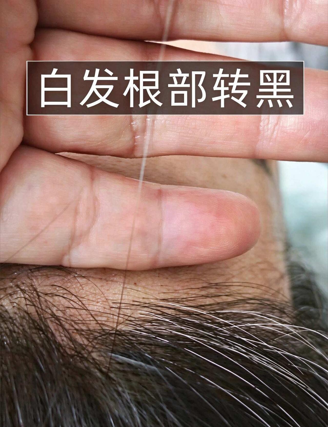 已听劝！后悔没早知道❗️❗️
白发 白发怎么办 少年白白发转黑 养发 少白头 斑