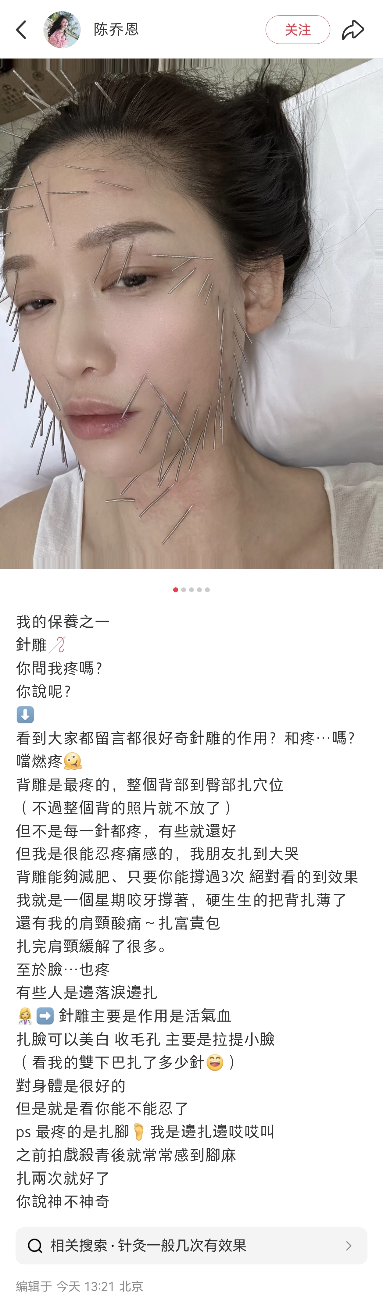 陈乔恩“满脸扎针”晒保养方法引热议，表示“对身体是很好的，就