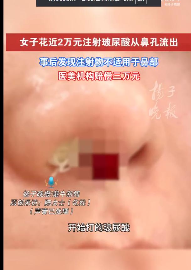 浙江杭州，女子花18800元注射玻尿酸隆鼻，约半小时后感觉鼻子堵塞，以为流鼻涕用