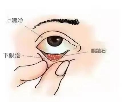 日常生活中，你是否被眼睛异物感所困扰？频繁的揉眼也不能缓解，时间久了后，还可能出现畏光、流泪、刺痛的症状，那么你可能遇上“结膜结石”了！