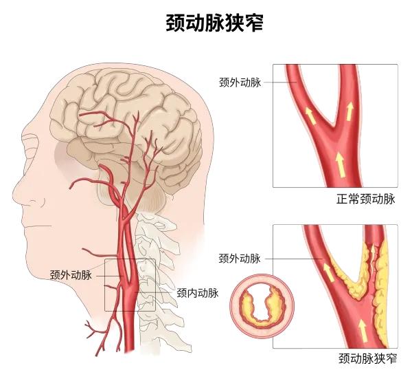 “猝”不及防，要小心颈动脉疾病破门而入！

今天想和大家聊聊一个悄无声息的健康“