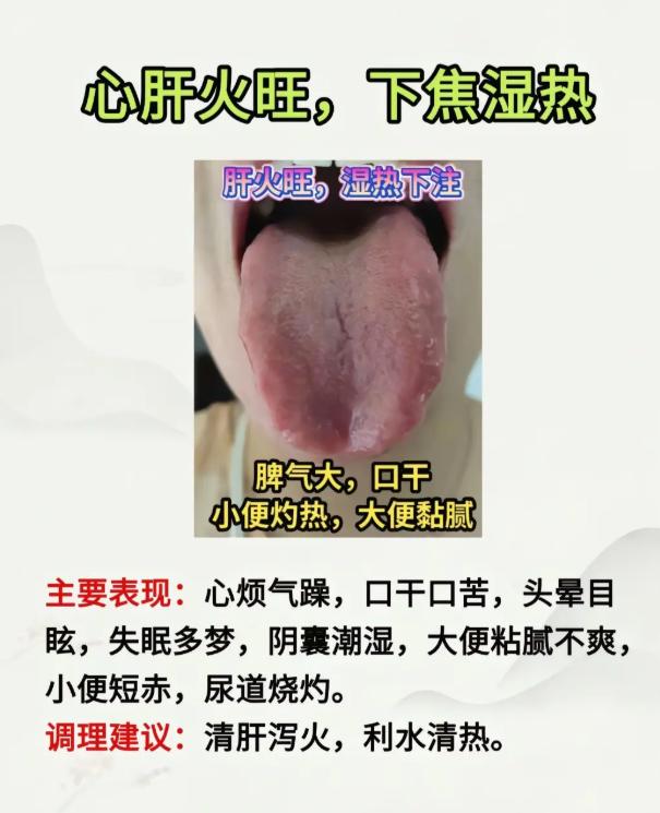 3 种常见复合体质舌象，对照自查，精准辨证
