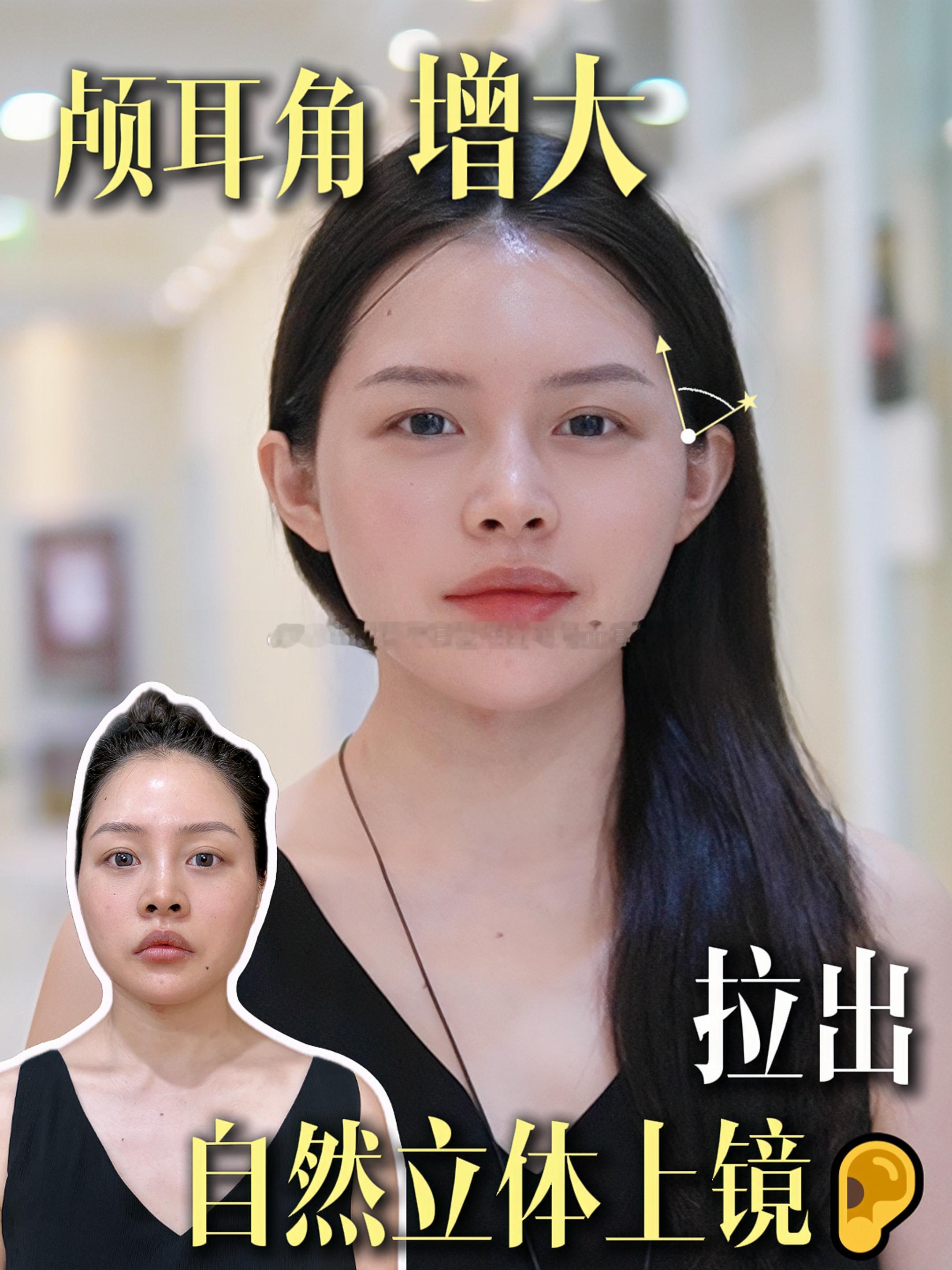 膨体精灵耳