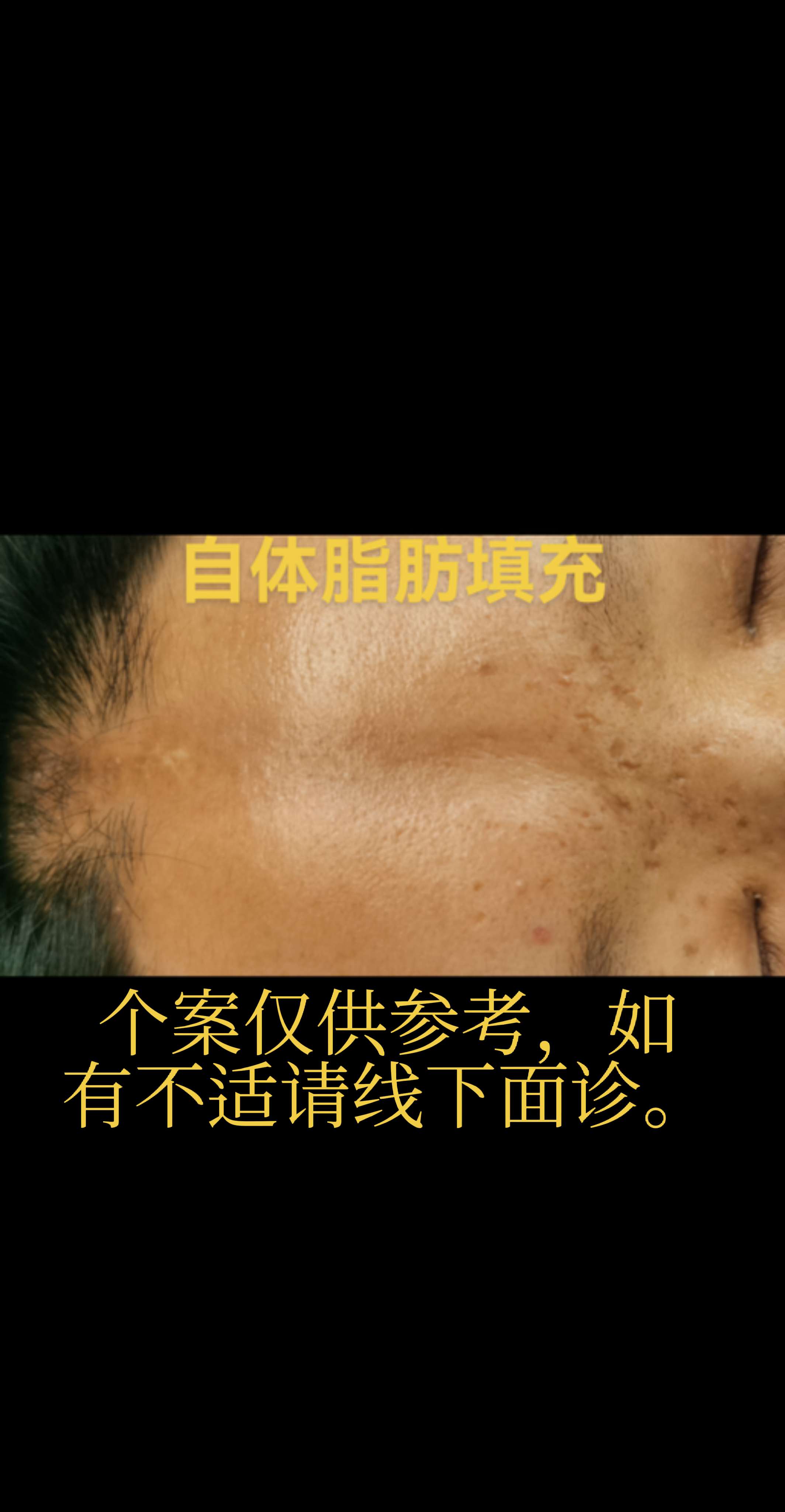 脂肪填充。额面部凹陷。