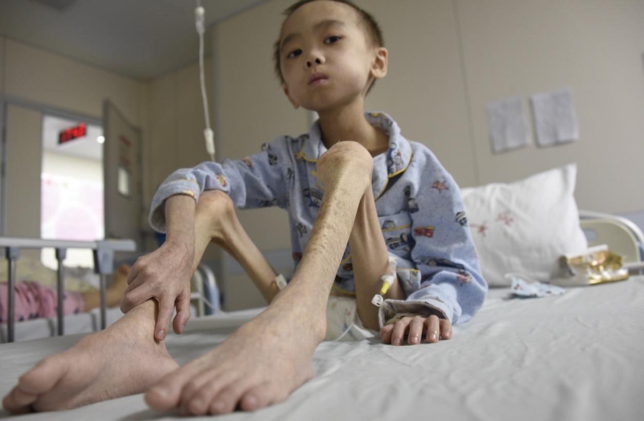 “别拿饮料当水喝！”尿毒症患者的泣血忠告

一杯冰可乐、一瓶甜奶茶，似乎是现代人