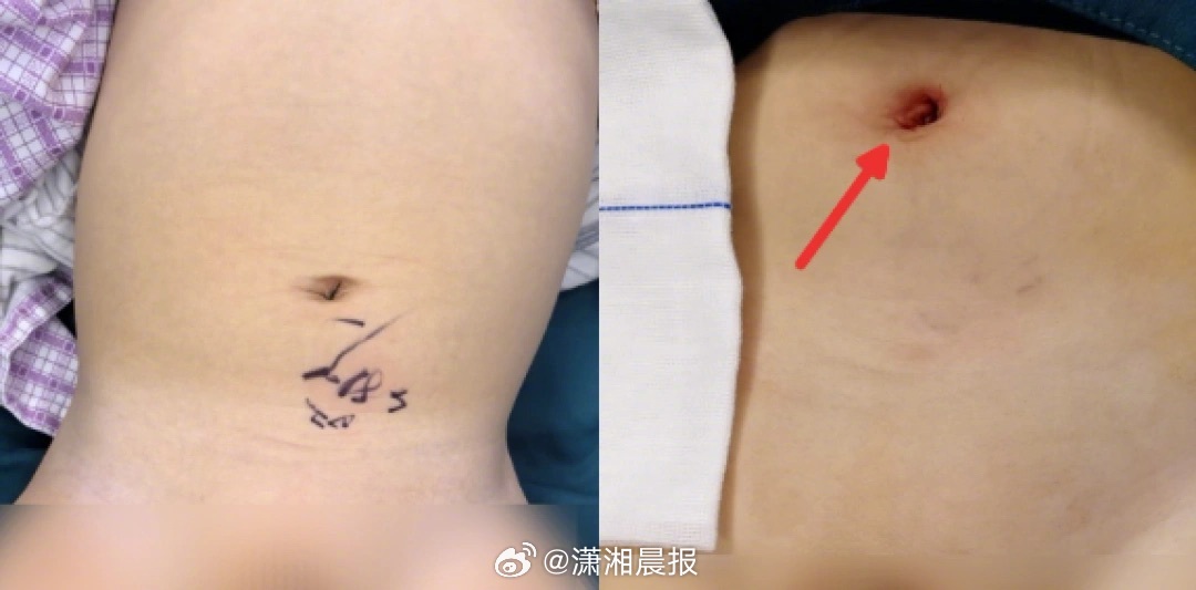 【#洗澡摸不到宝宝的蛋蛋可能是隐睾#！#半岁至一岁半为隐睾黄金治疗期#】洗澡时突