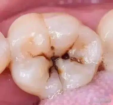 每天刷牙，为什么牙齿还是坏了？这些老习惯，从一开始就错了
 
“每天都认真刷牙，