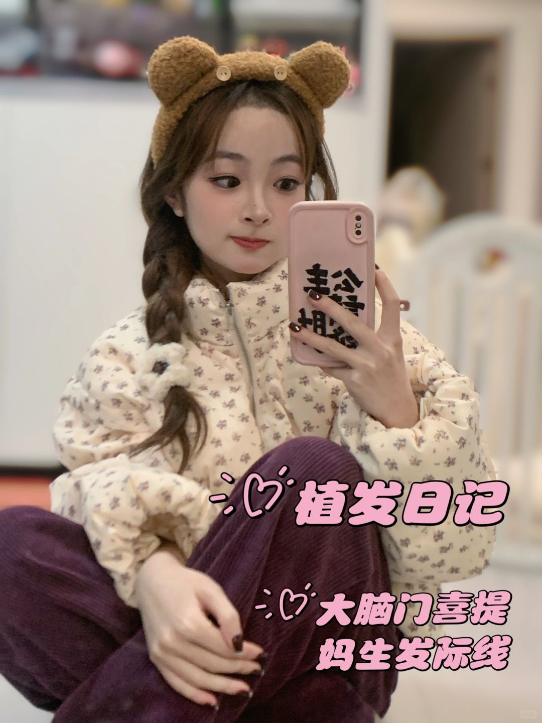 植发日记📔大脑门喜提妈生发际线啦