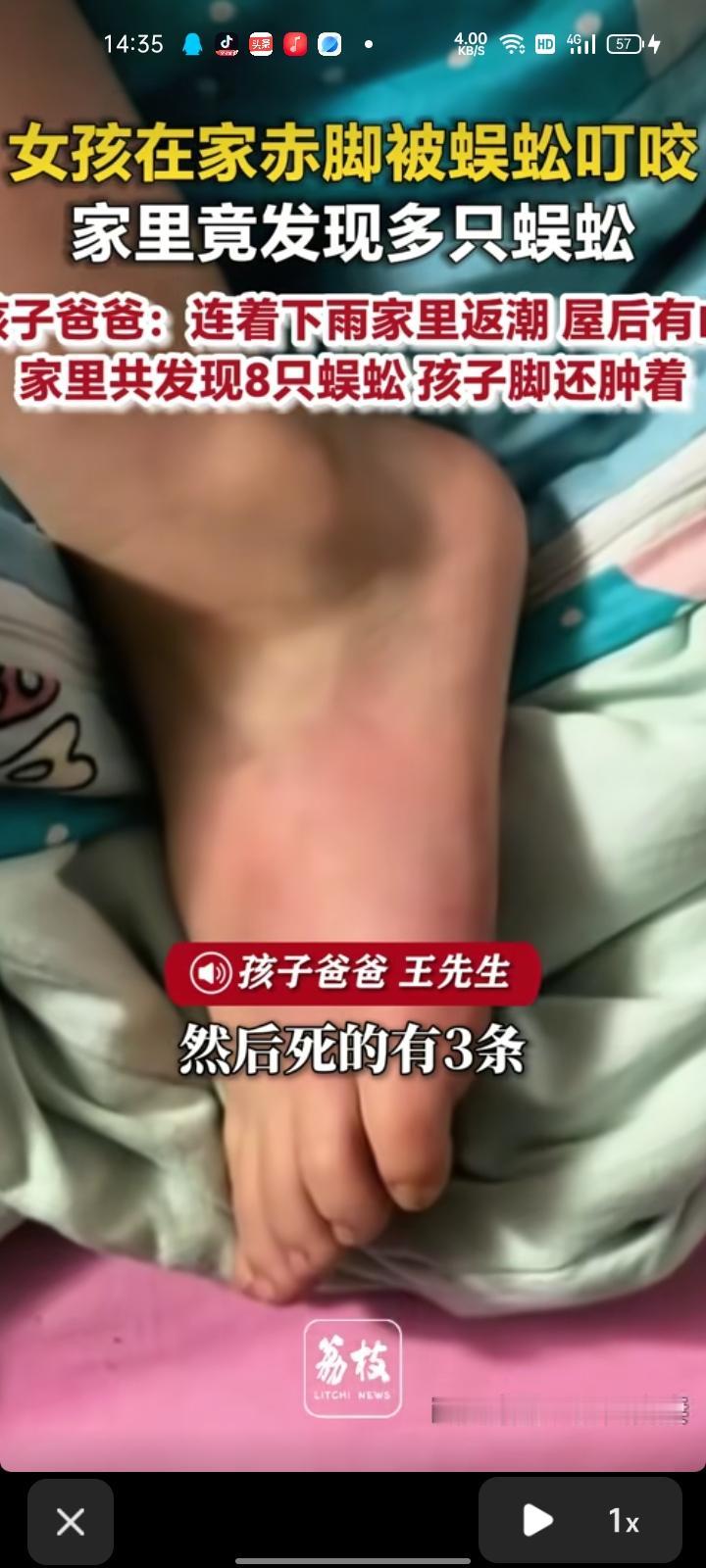 5月17日，达州市渠县。网友发视频称，女儿在家里打赤脚，被蜈蚣叮咬后疼哭了。四川