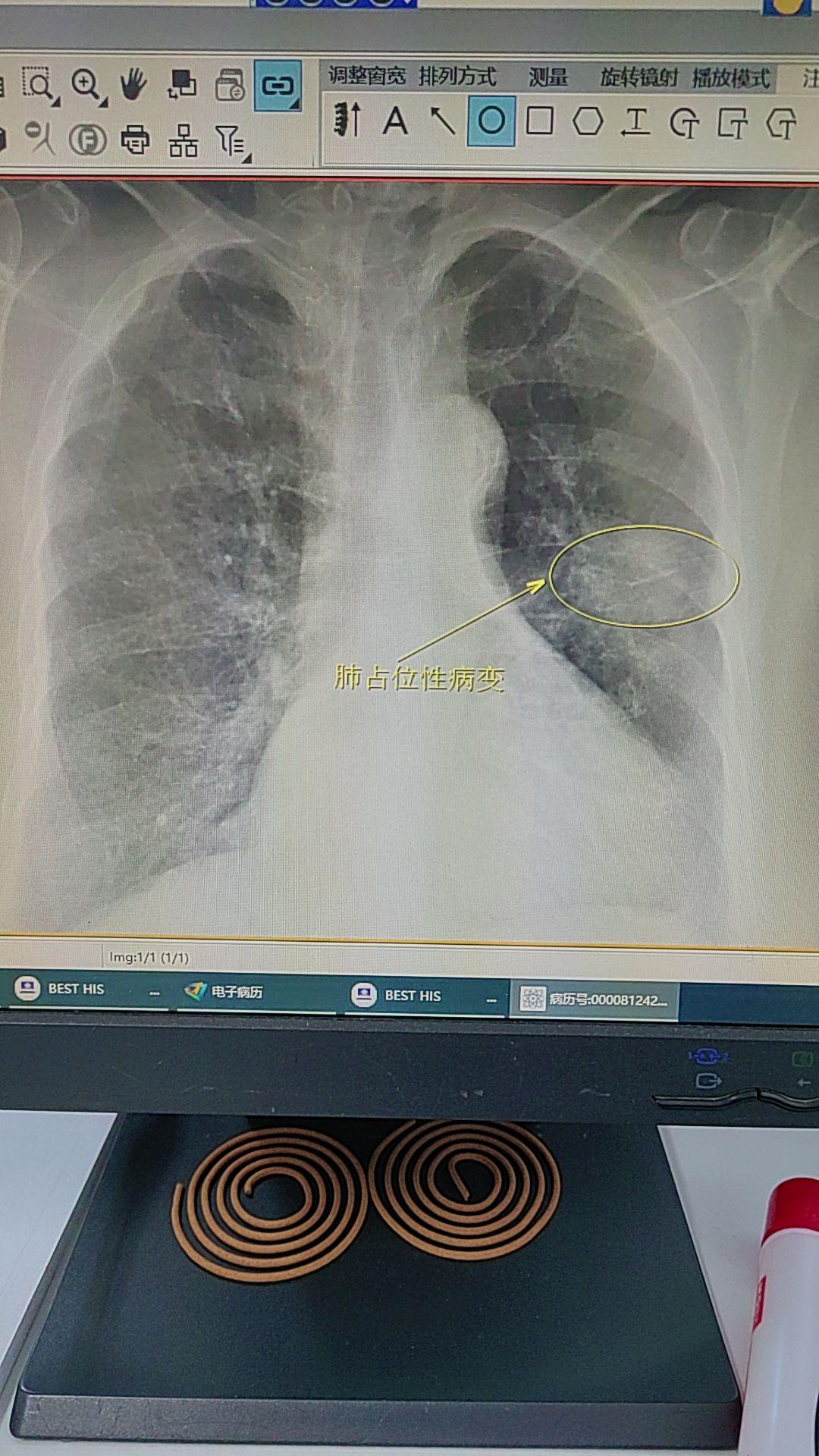 胸片提示左肺团块影。必须要做CT检查了，进一步明确诊断。