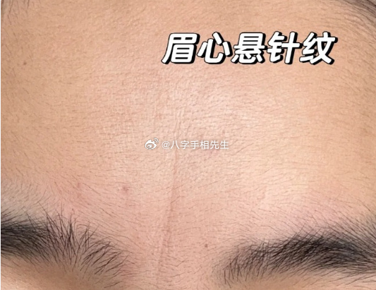 经常皱眉头的人，眉间会形成悬针纹，又叫烦恼线。久而久之，拧巴苦命相越重，也代表了