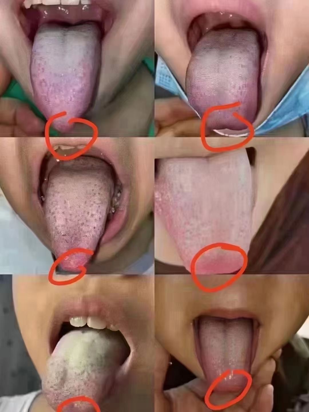 #中医##育儿专家说##康尧小儿推拿# ✅什么样的孩子最容易咳嗽有鼻炎❓1⃣舌头