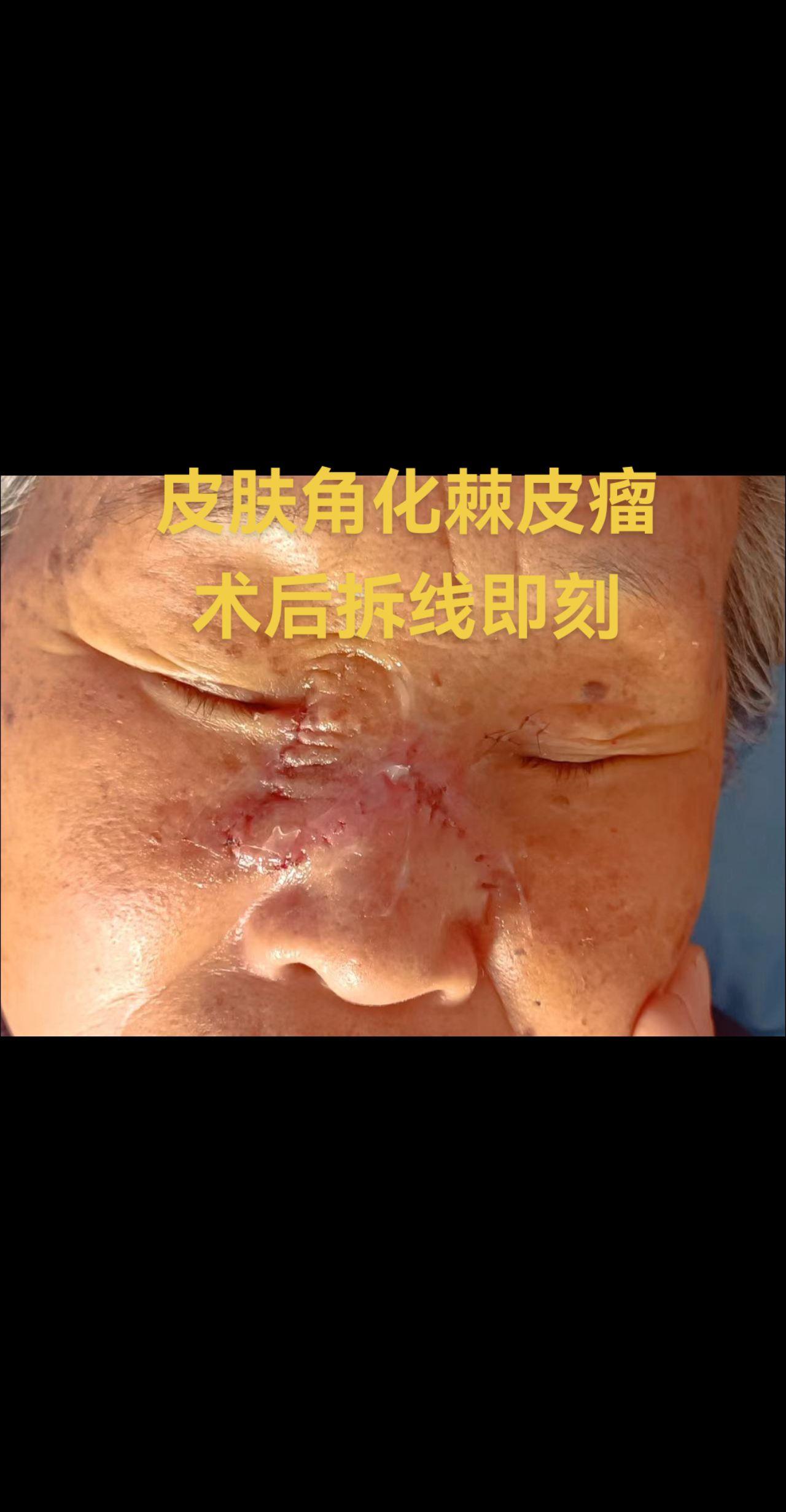 角化棘皮瘤是一种少见的、生长很快的皮肤良性肿瘤，具有自行消退的特征，但...
