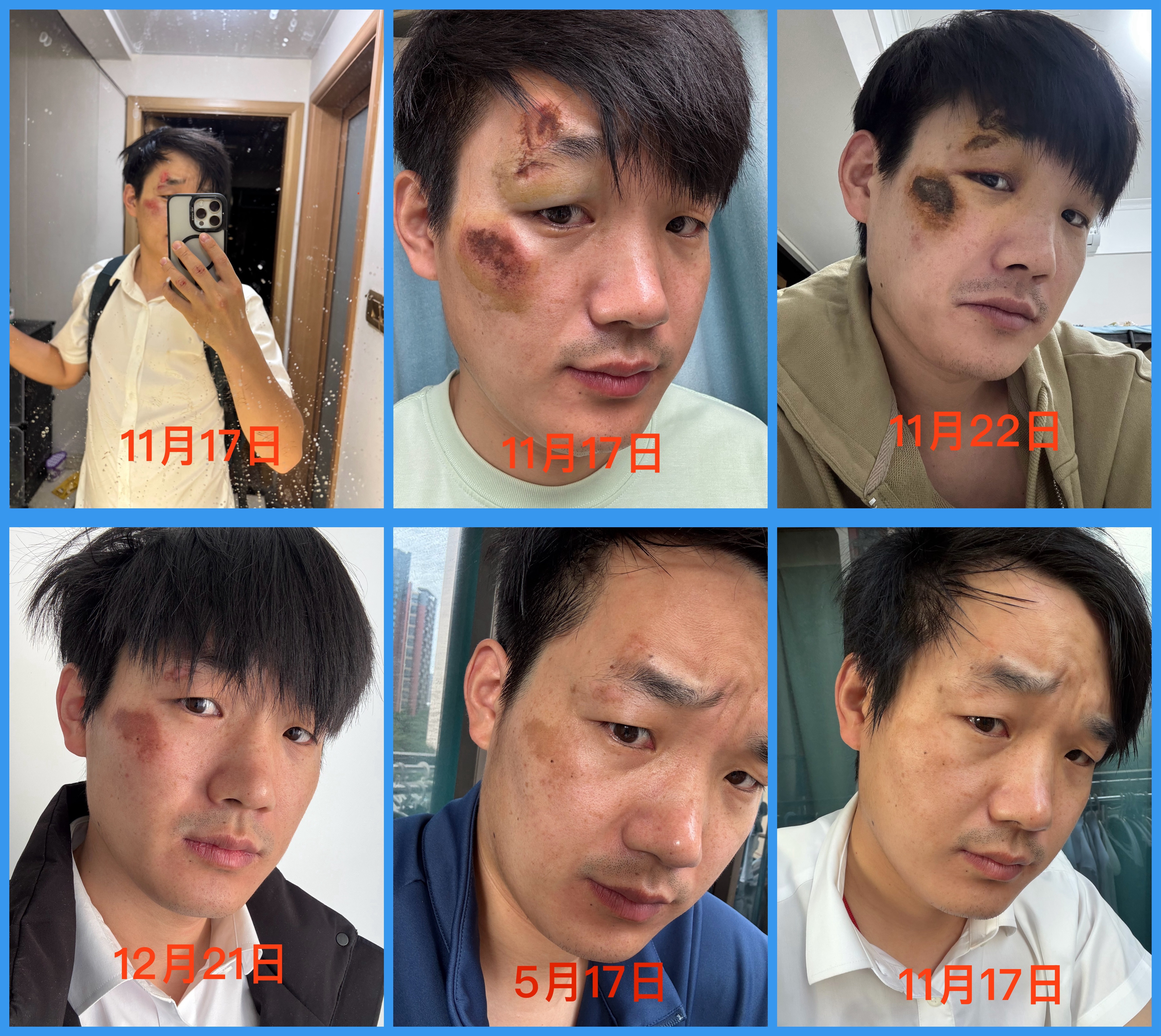 今天刚好一年，去年骑滑板车摔到脸，好了之后留下的黑色素沉淀，现在已经淡化很多了，