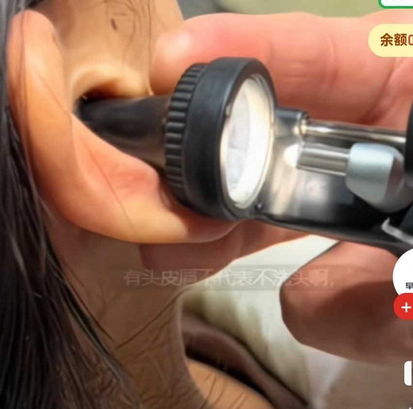 医生说女子耳道状态非常严重，异物松动的瞬间，
女子急忙推开医生的器械，
医生大喊