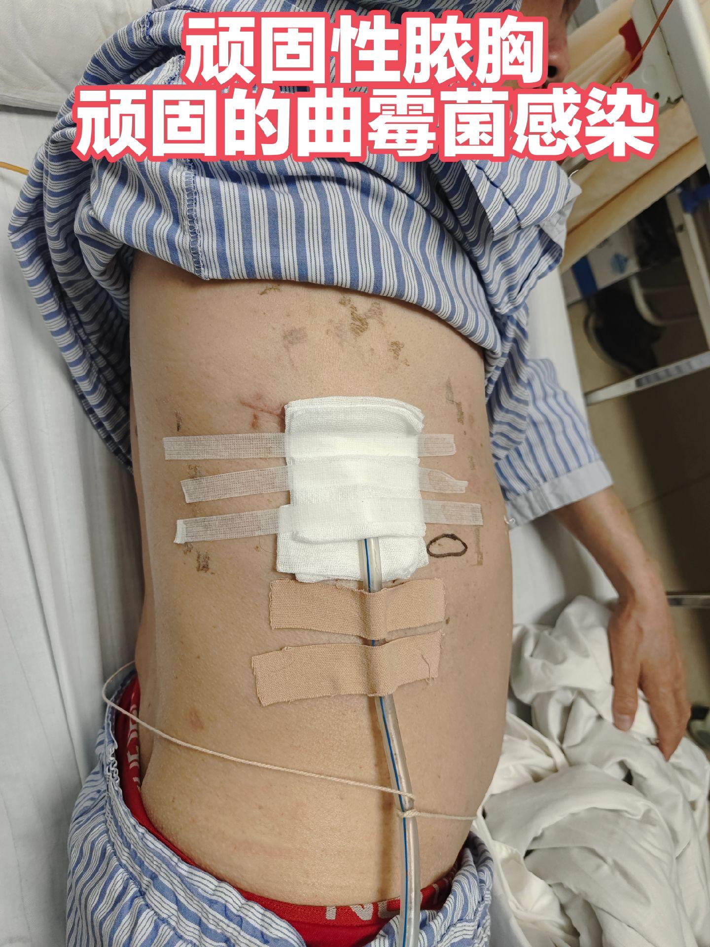 顽固性脓胸，顽固的曲霉菌感染，只能终身带管？以外科之利刃，扫除一切牛鬼...