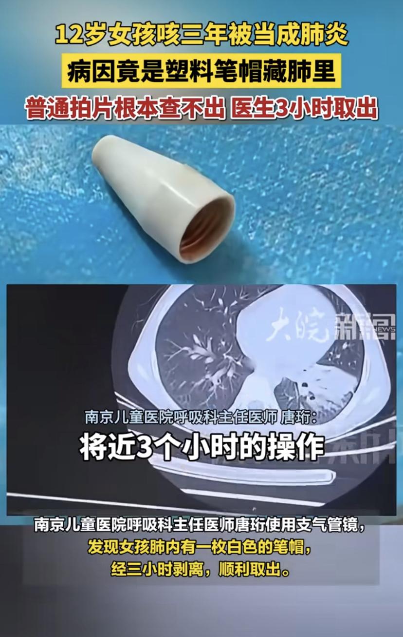 憋了三年!12岁女孩反复咳嗽治不好，罪魁祸首竟是三年前"弄丢"的一个笔帽!
南京
